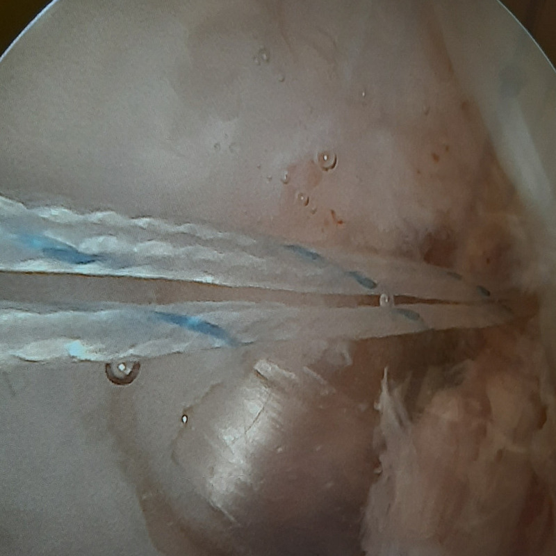 Afectiune ligamente genunchi