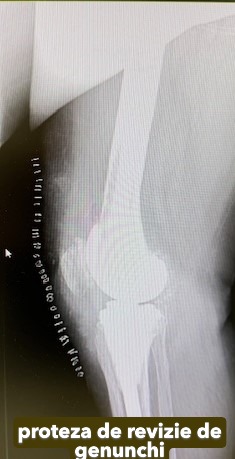 Fractura tratata de dr Chitea Claudiu Daniel