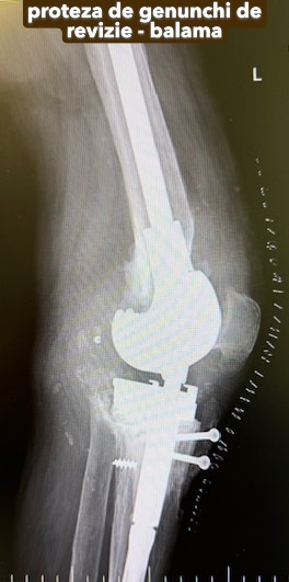 Fractura tratata de dr Chitea Claudiu Daniel