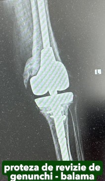 Fractura tratata de dr Chitea Claudiu Daniel