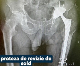 Fractura tratata de dr Chitea Claudiu Daniel