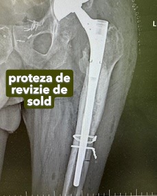 Fractura tratata de dr Chitea Claudiu Daniel
