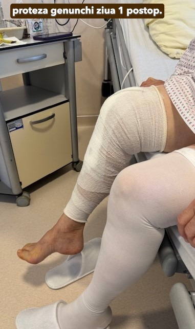 Fractura tratata de dr Chitea Claudiu Daniel