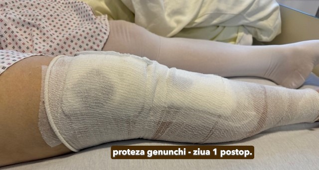 Fractura tratata de dr Chitea Claudiu Daniel