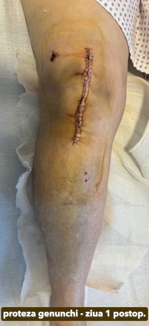 Fractura tratata de dr Chitea Claudiu Daniel