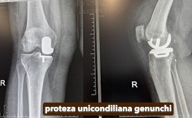 Fractura tratata de dr Chitea Claudiu Daniel