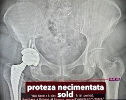 Fractura tratata de dr Chitea Claudiu Daniel