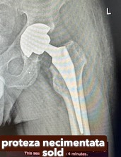 Fractura tratata de dr Chitea Claudiu Daniel