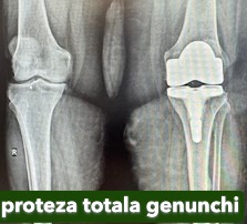 Fractura tratata de dr Chitea Claudiu Daniel