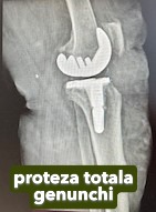 Fractura tratata de dr Chitea Claudiu Daniel